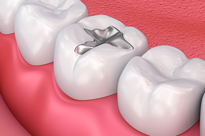 The image displays a close-up view of a dental implant, which is a metallic screw-like component inserted into the jawbone to replace a missing tooth.