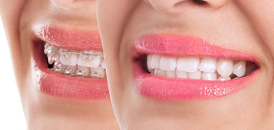 A side-by-side comparison of a person s natural smile and their smile with braces, showcasing the transformative effect of orthodontic treatment.