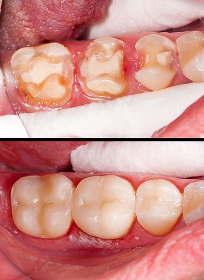 Before and after dental implant comparison, showing a mouth with missing teeth transitioning to one with restored teeth.