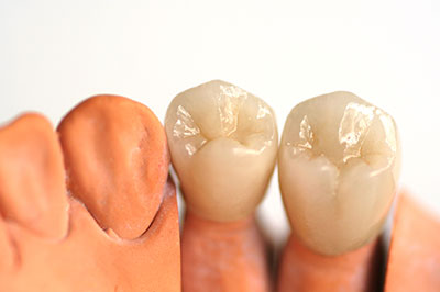 The image shows a set of three artificial teeth with visible root structures, placed side by side against a white background.