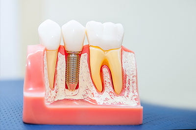 The image shows a dental model with multiple teeth, some of which have fillings or caps, and one tooth has a visible metal screw.