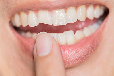 An image of a person holding a finger to their mouth, revealing a tooth with a missing front tooth.