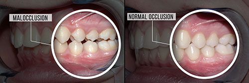 The image shows a side-by-side comparison of two dental X-rays, with one X-ray displaying an intact tooth structure and the other showing severe tooth decay.