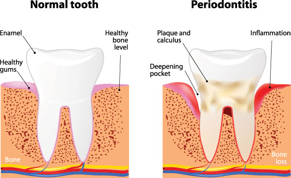 The image is a medical illustration showing the stages of normal tooth development and gum health, with annotations indicating  Periodontitis  and highlighting areas of inflammation and bone loss.