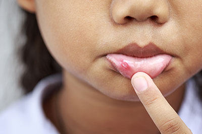 A young girl with a noticeable pimple on her chin, holding her finger to it.