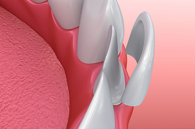 The image shows a close-up view of dental implants, with a focus on the screws and surrounding tissue, set against a pink background that resembles gum tissue.