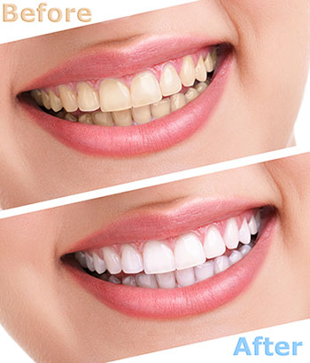 The image shows a comparison of teeth before and after a dental treatment, highlighting the transformation achieved by the procedure.