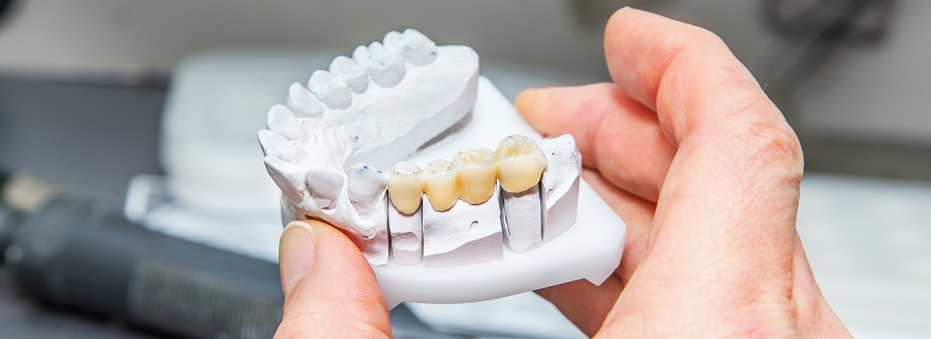 The image shows a person s hand holding a dental implant with multiple teeth attached to it.