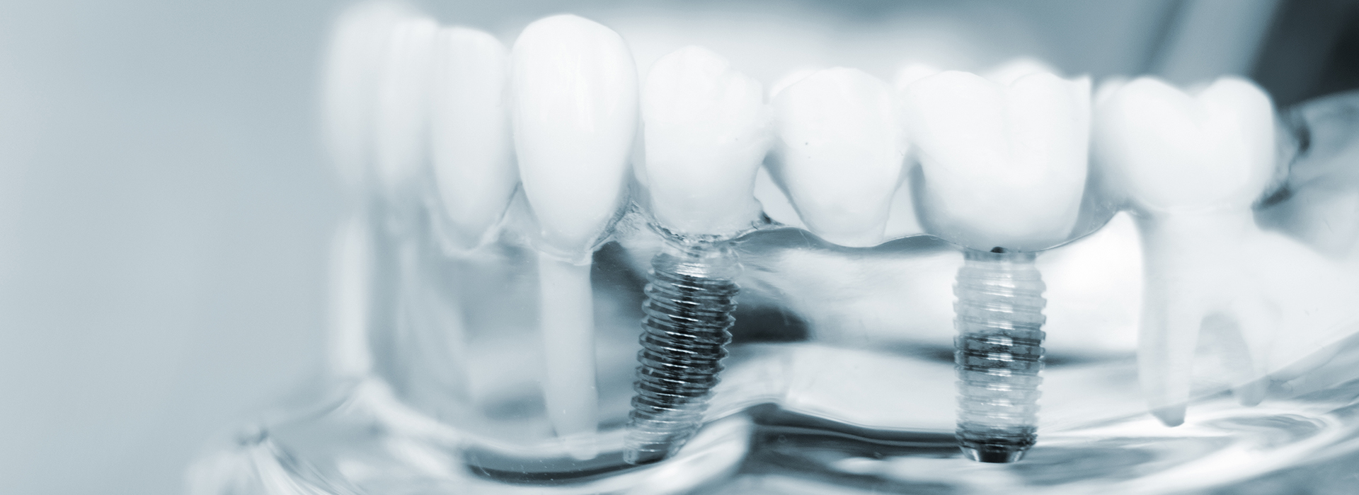 The image shows a close-up of a dental appliance, possibly a denture or a bridge, with visible screws and teeth, set against a blurred background that appears to be a mouth.