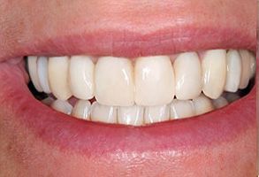 The image shows a person with a broad smile, displaying teeth that are well-maintained and white in color.