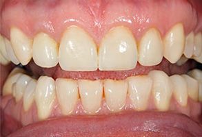 The image shows a close-up of a person s teeth with visible staining or discoloration, particularly on the front teeth.