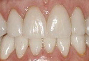 The image shows a close-up of a person s teeth with a focus on the upper front teeth, which appear to be in need of cosmetic dental work due to their yellowish discoloration and uneven alignment.