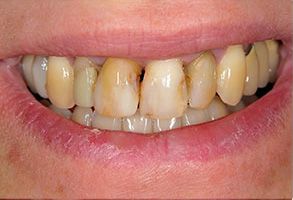 The image shows a close-up of a person s mouth with yellowed teeth, and the individual is smiling.